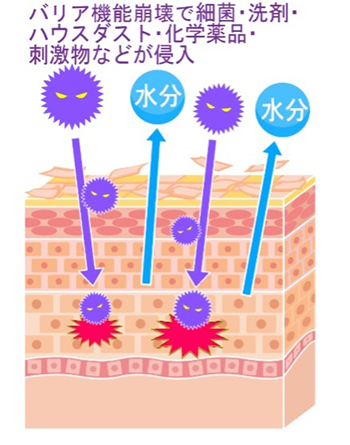 アトピー性皮膚炎の症状