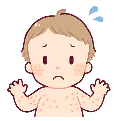 水ぼうそう（水痘）