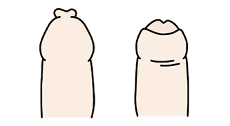 真性包茎
